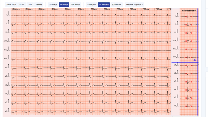 EKG